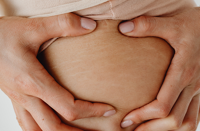 SHE SAYS: I Didn’t Like My Post-pregnancy Stretch Marks But I Grew Into it