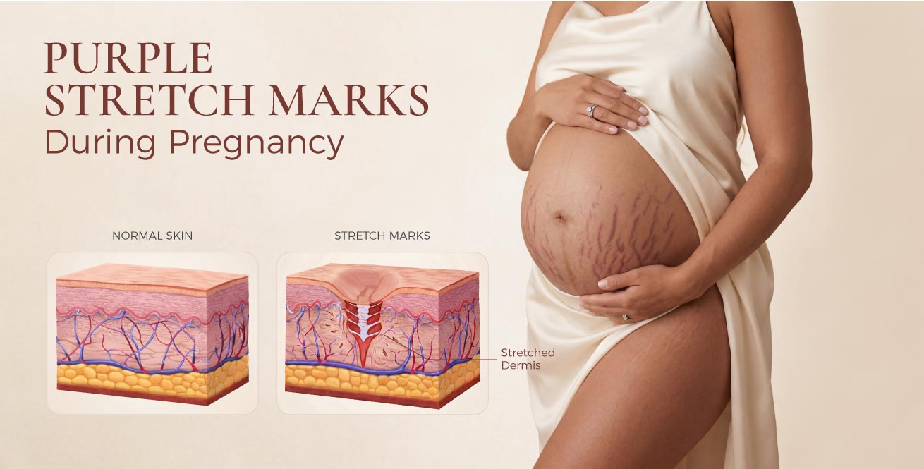 Purple Stretch Marks During Pregnancy: What They Mean and How Stretch Mark Cream Can Help